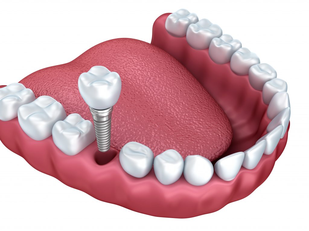 who has the best dental implants in greenville sc?
