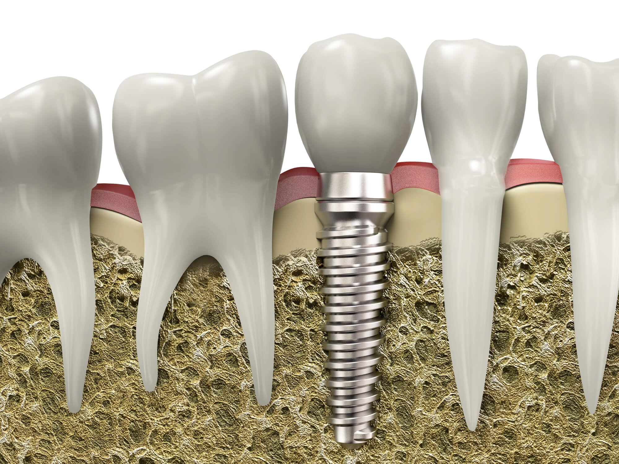 who offers dental implants simpsonville sc?