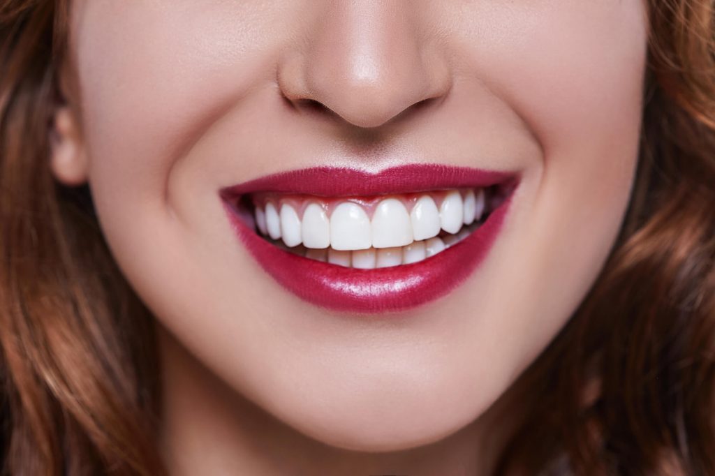 what is veneers greenville SC?