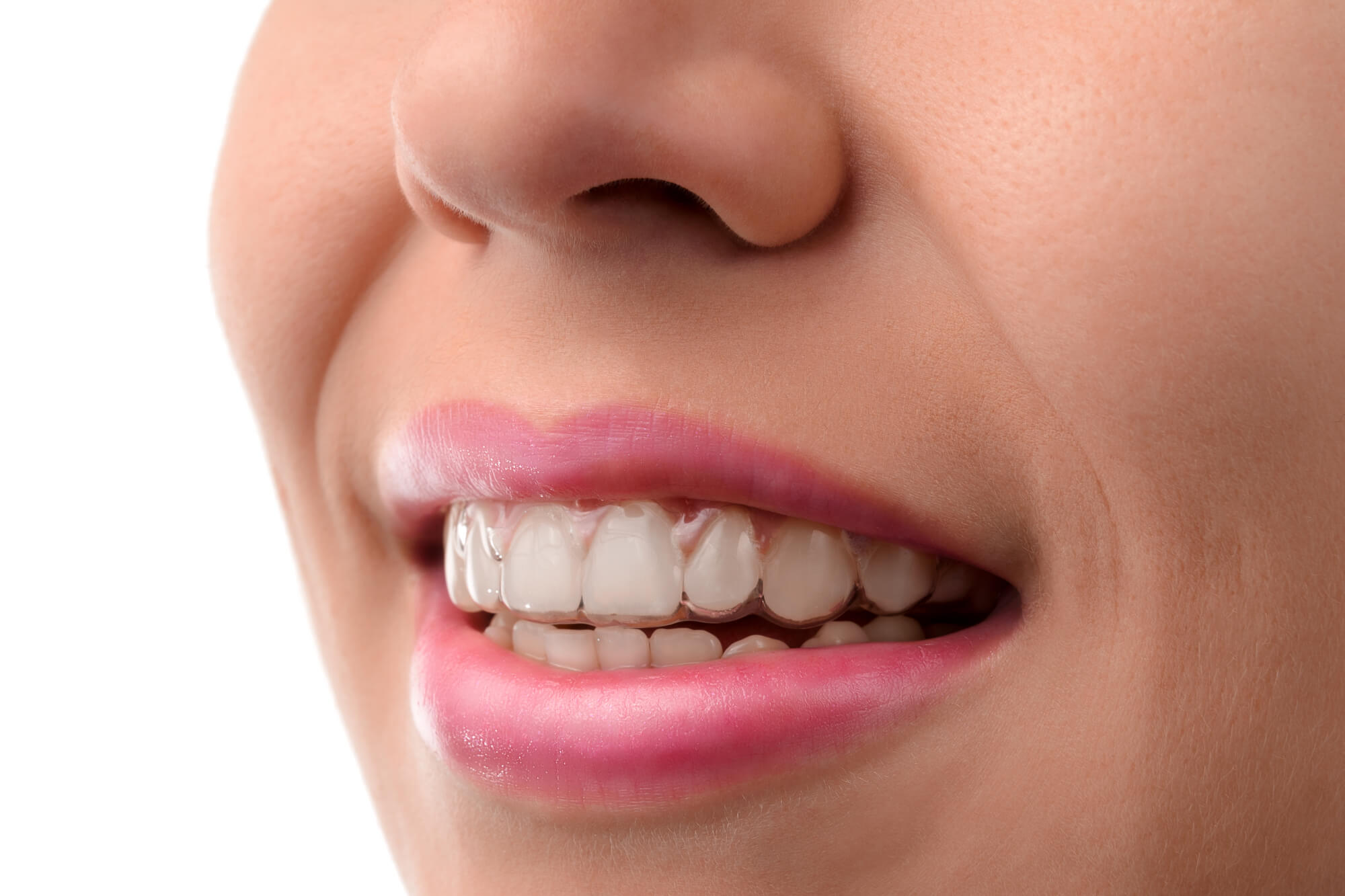 where is the best place to get invisalign greenville sc?