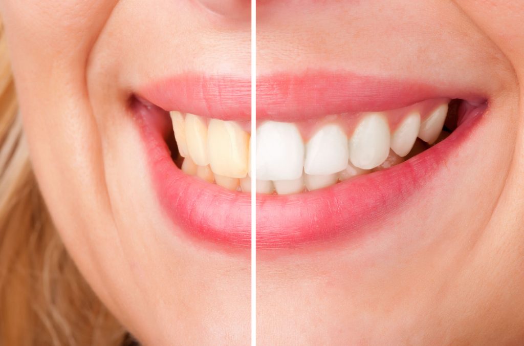 where is the best teeth whitening greenville sc?