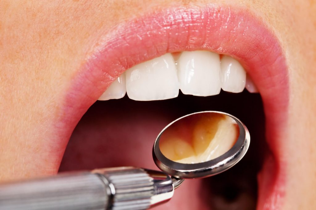 where are the best tooth extraction simpsonville sc?