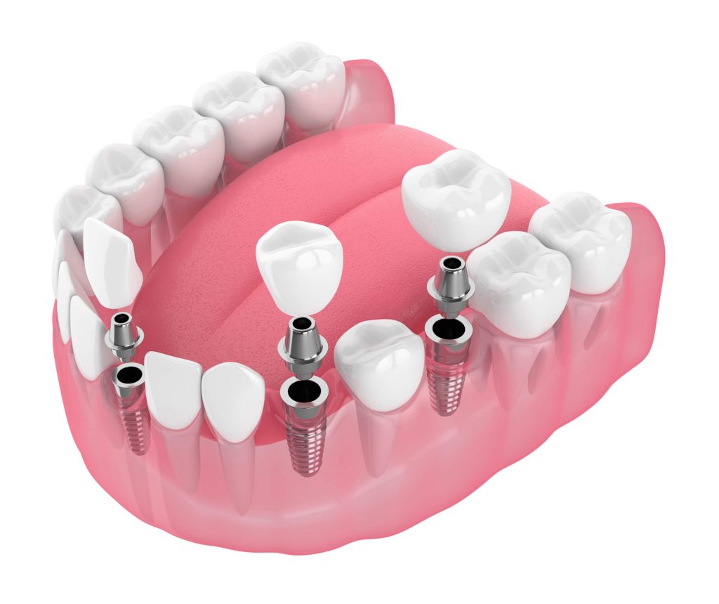 Where to get Dental Implants Simpsonville SC?