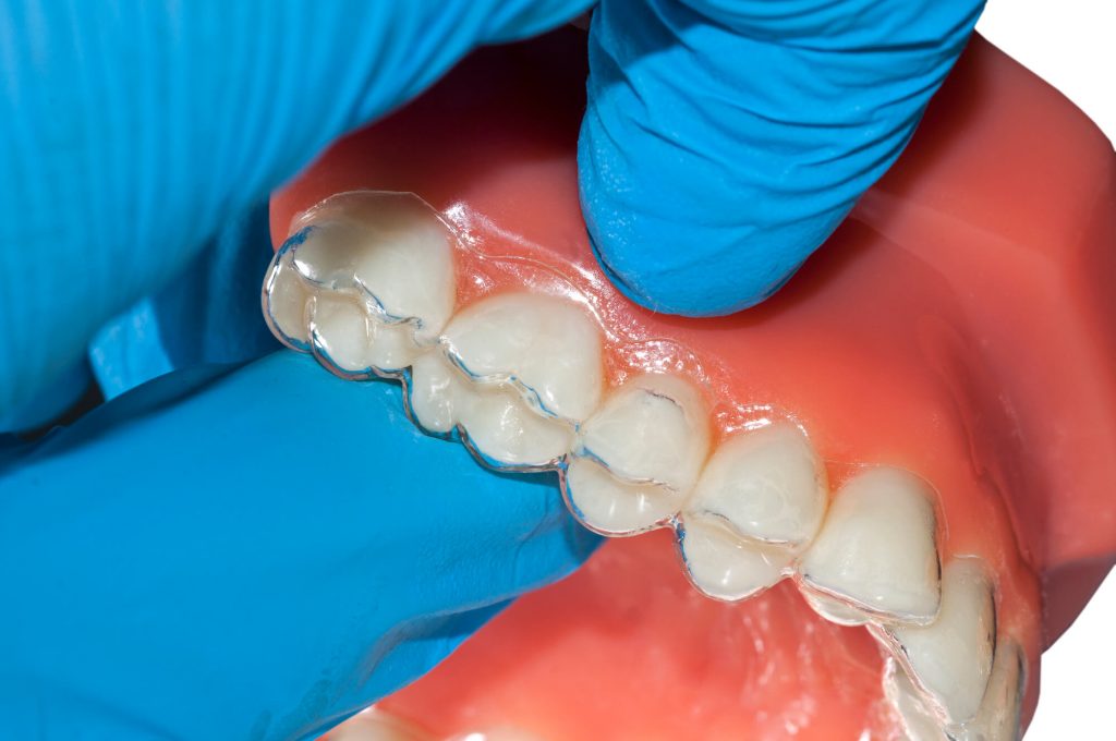 where can i get invisalign in simpsonville sc?