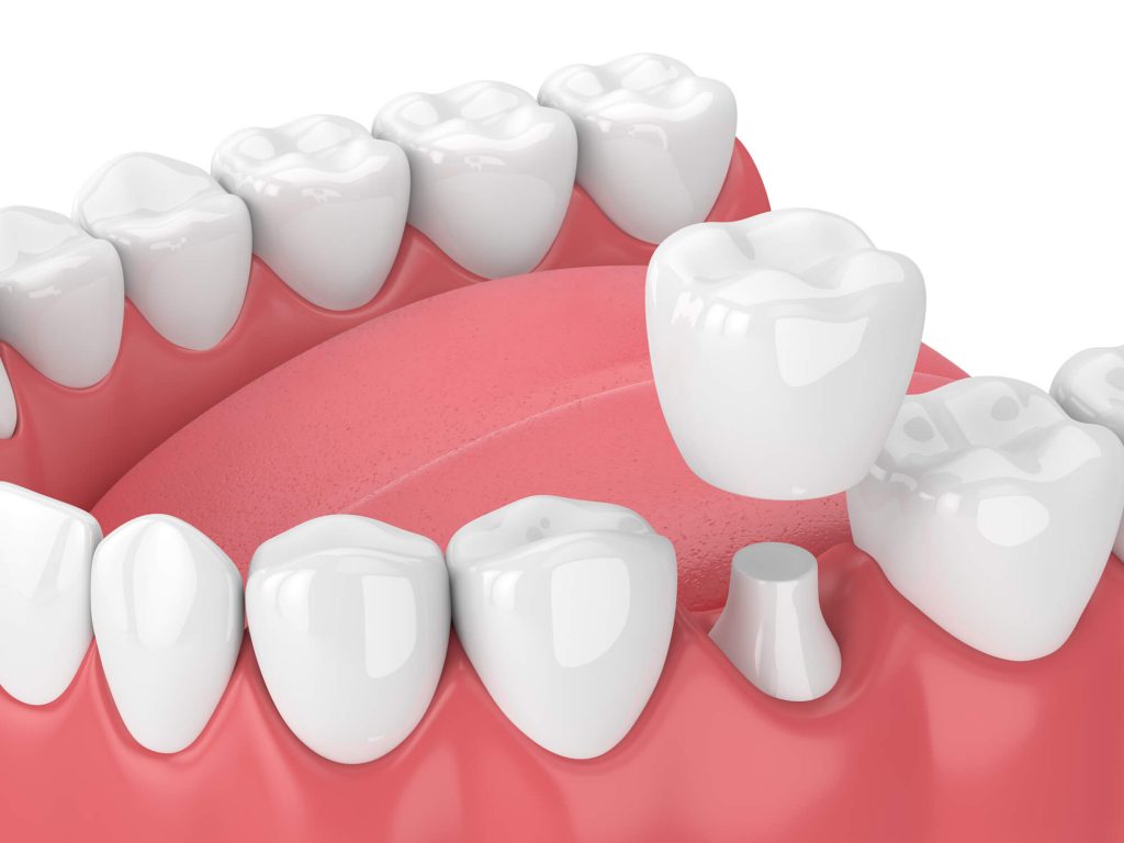 What are dental crowns Simpsonville SC?
