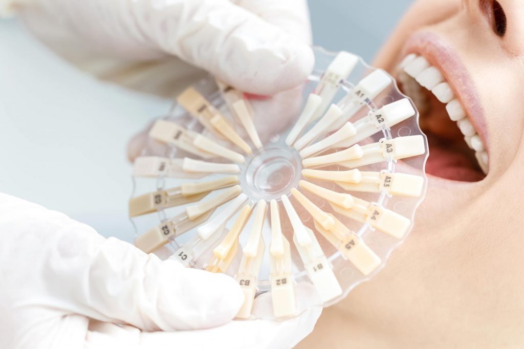 teeth whitening Simpsonville SC