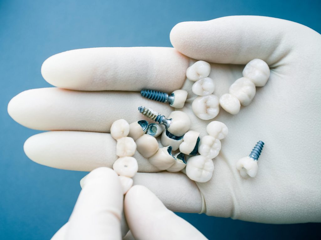dental implants Greenville SC