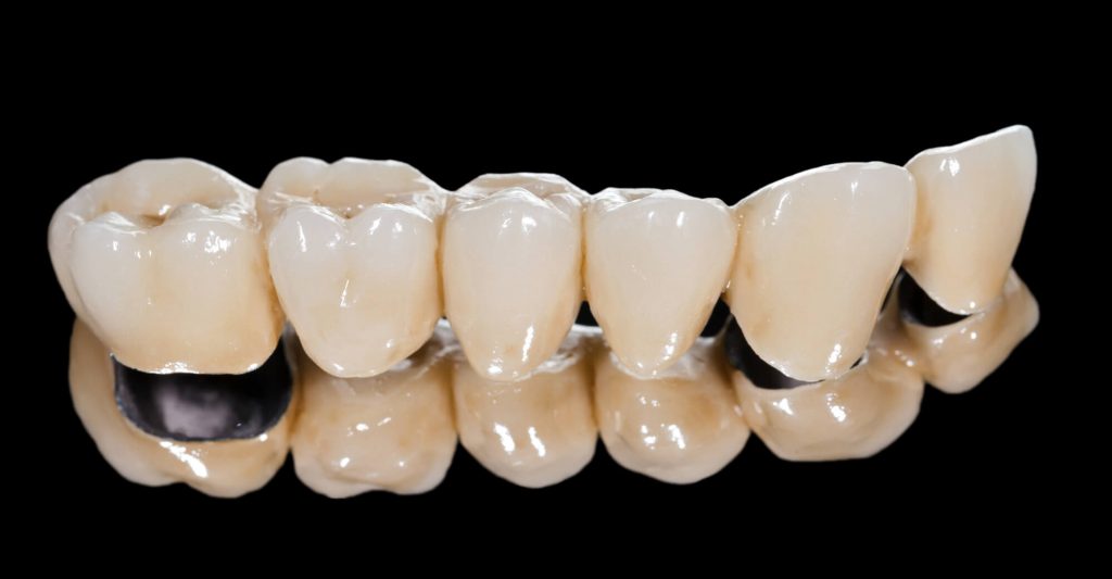 close up image of crowns Greenville, SC