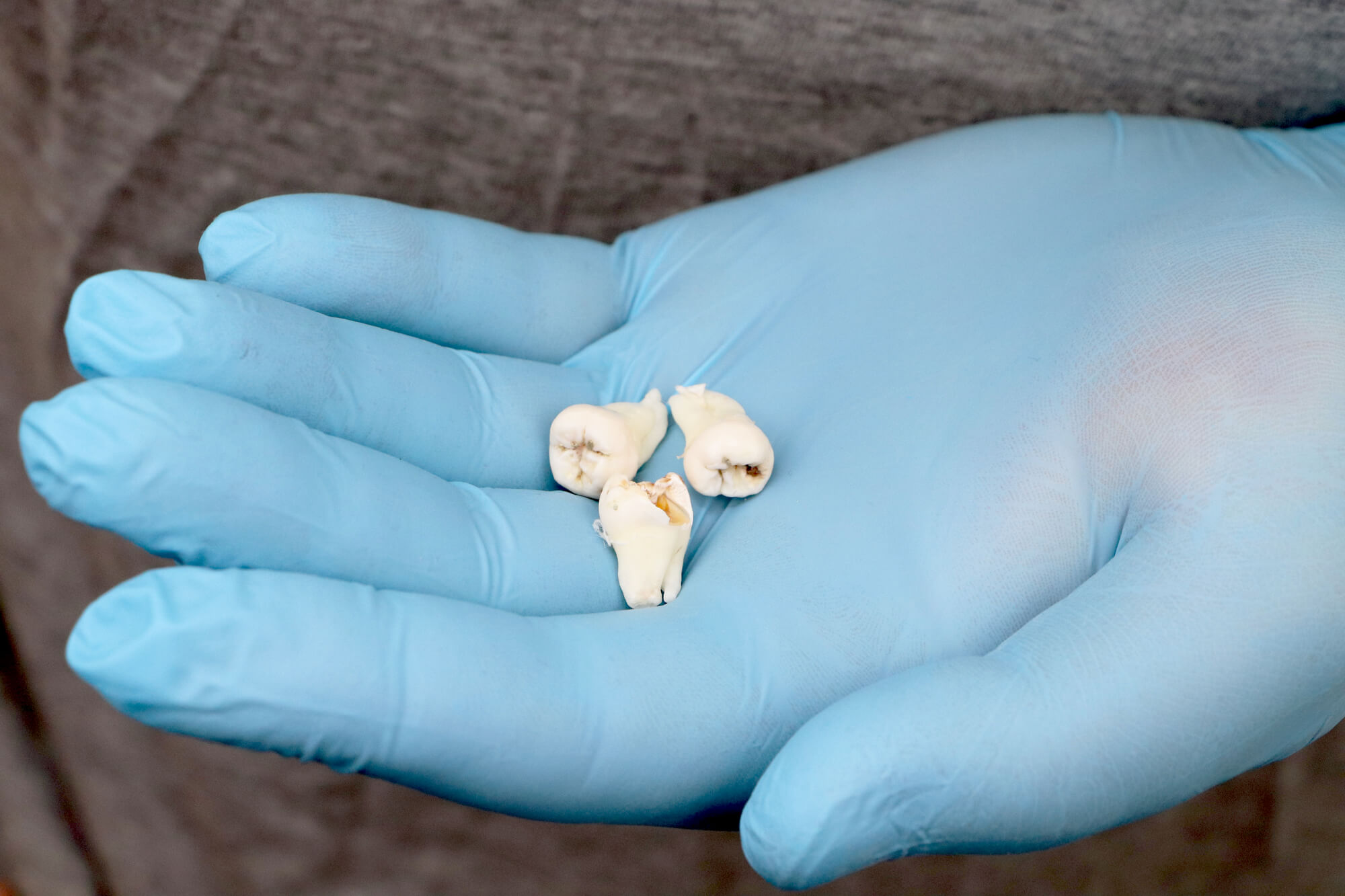 dentist holding a few wisdom teeth from Simpsonville, SC