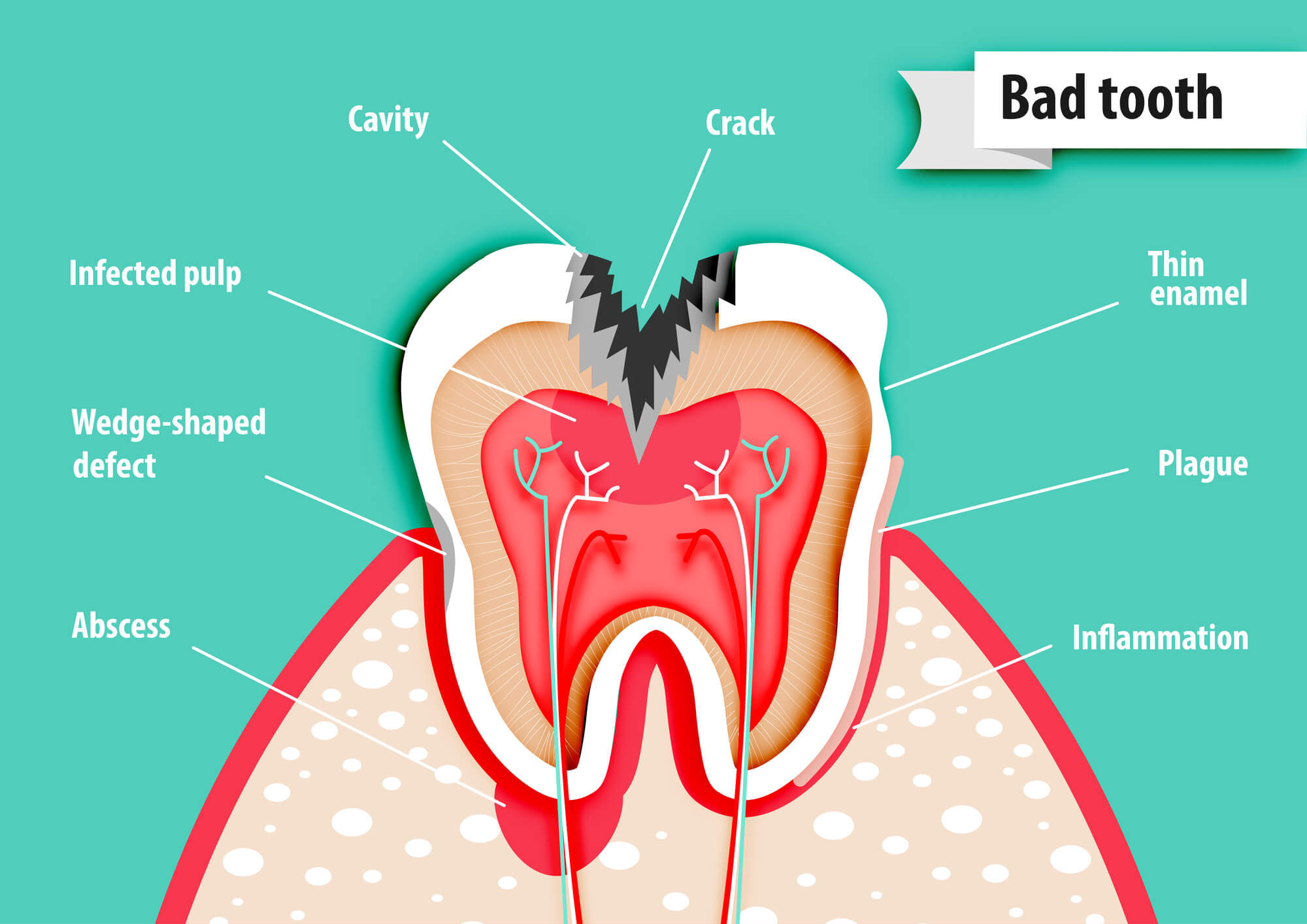 illustration of root canal in Greenville, SC