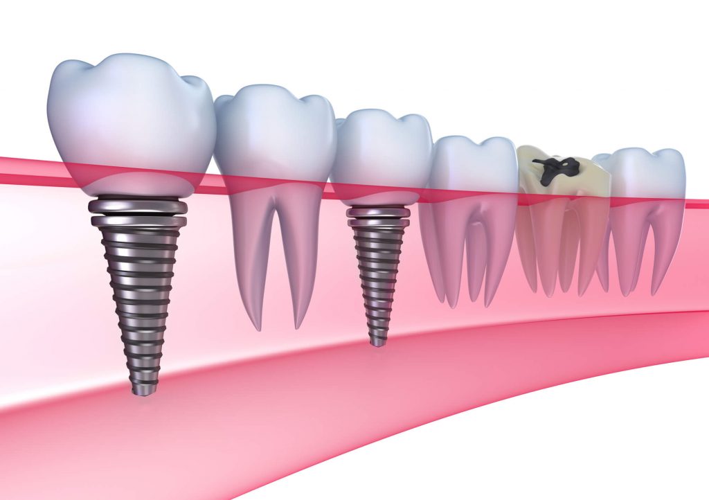 dental implants and root canal in Simpsonville, SC