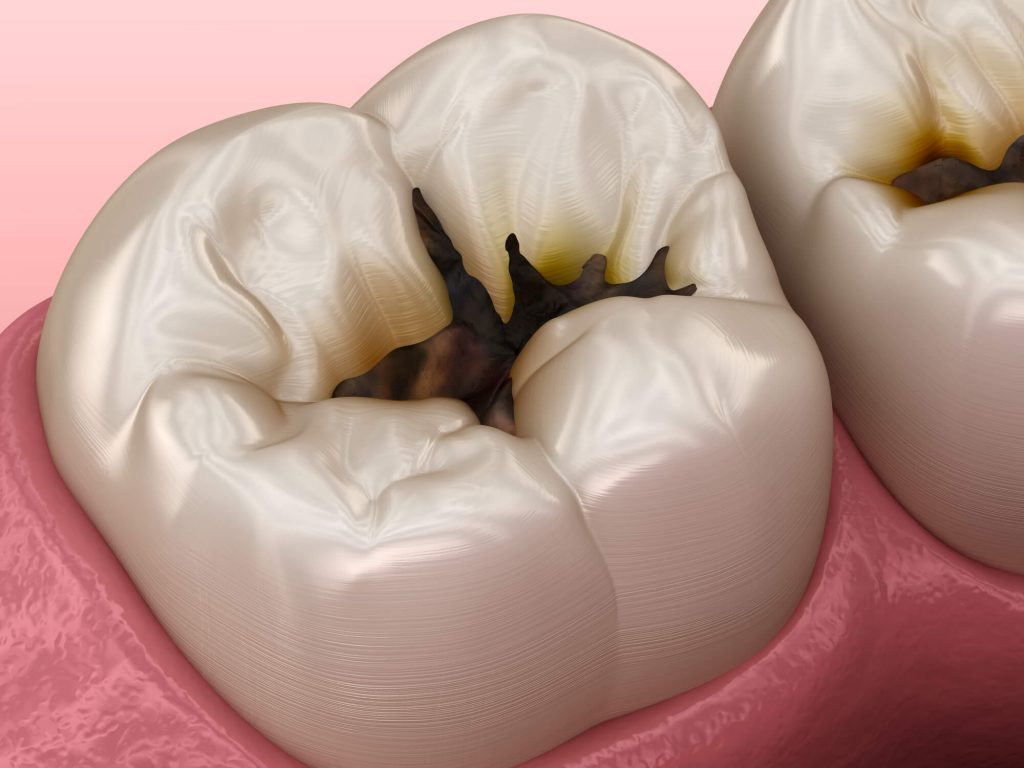 tooth needs root canal in Simpsonville, SC
