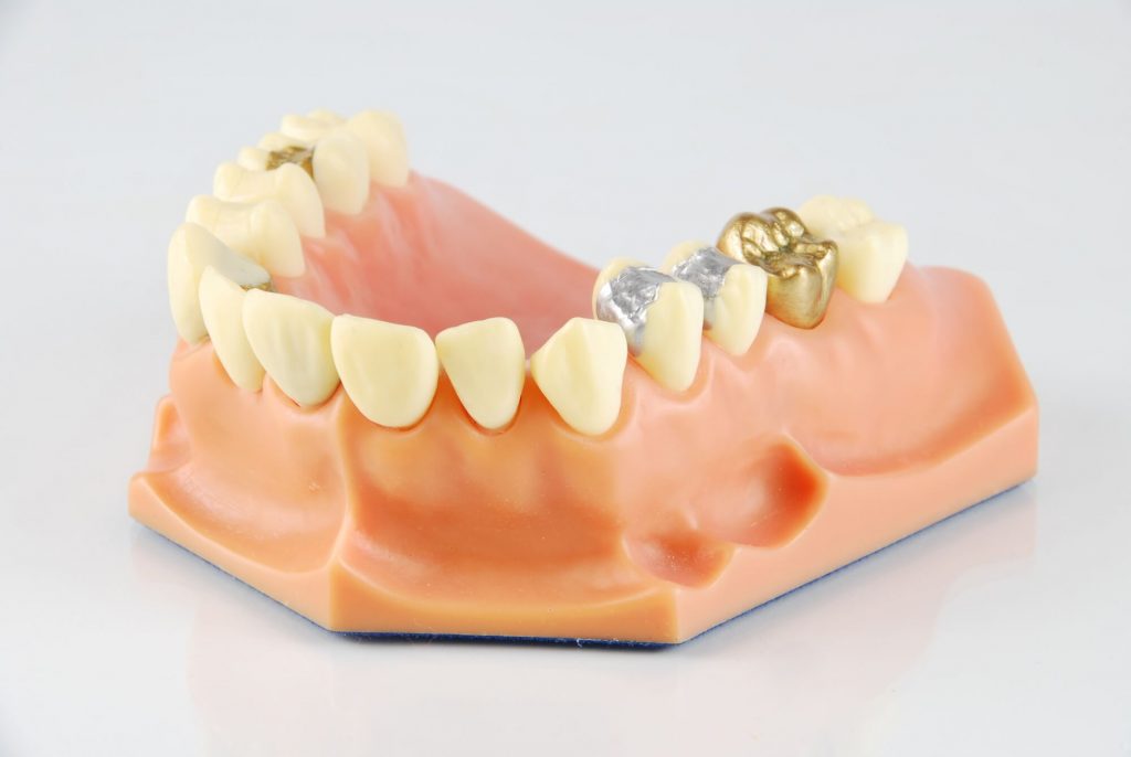 dental fillings and root canal in Simpsonville, SC
