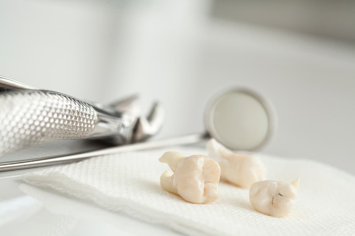 illustration of tooth extractions in Greenville SC