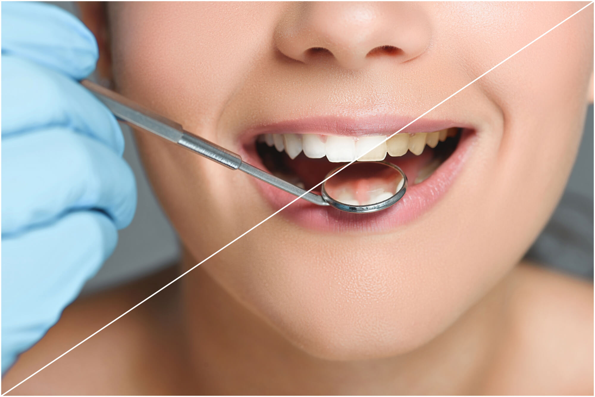 before and after teeth whitening in Greenville SC