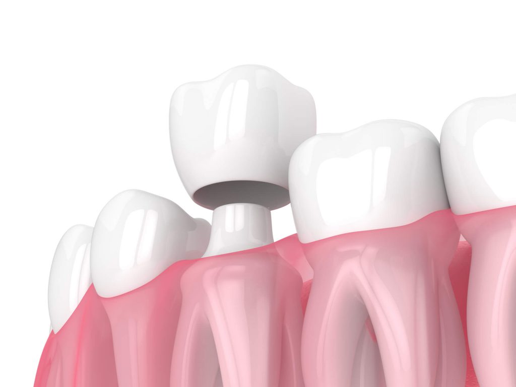 close up image of crowns in Greenville SC 