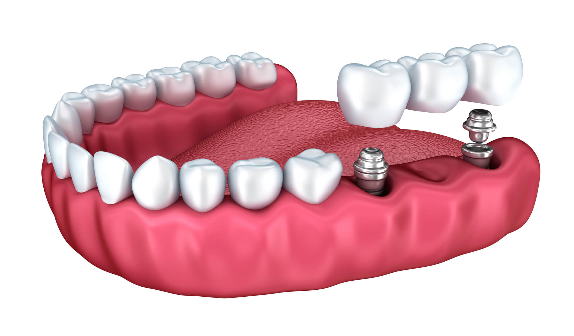 Illustration of dental implants in Simpsonville SC
