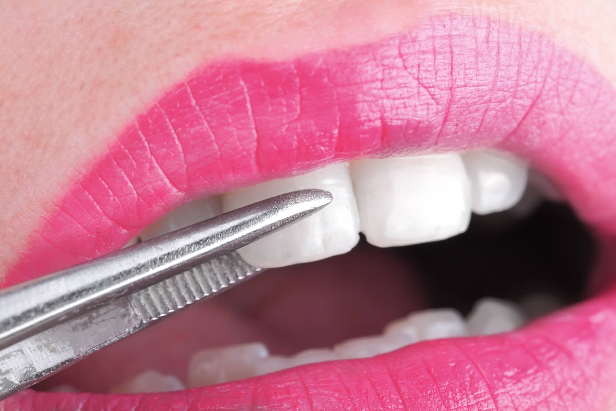 dental tool grabbing veneers in the mouth of a patient in simpsonville SC