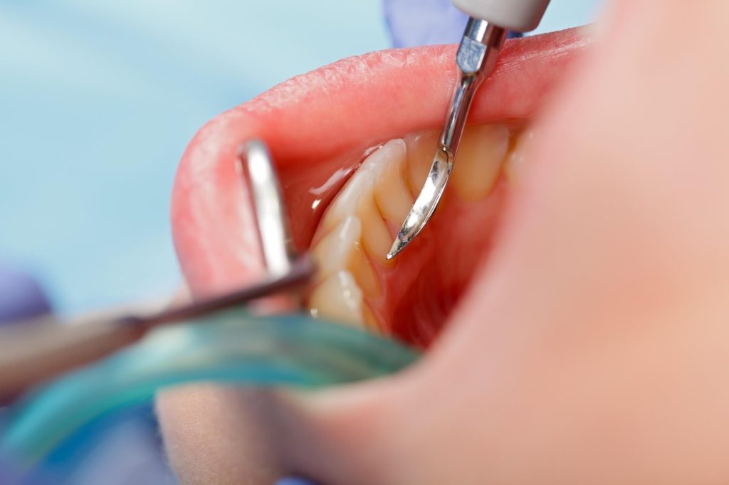 A patient receiving veneers in Greenville SC