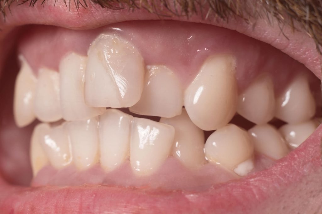 crooked teeth needing Invisalign in Greenville SC 