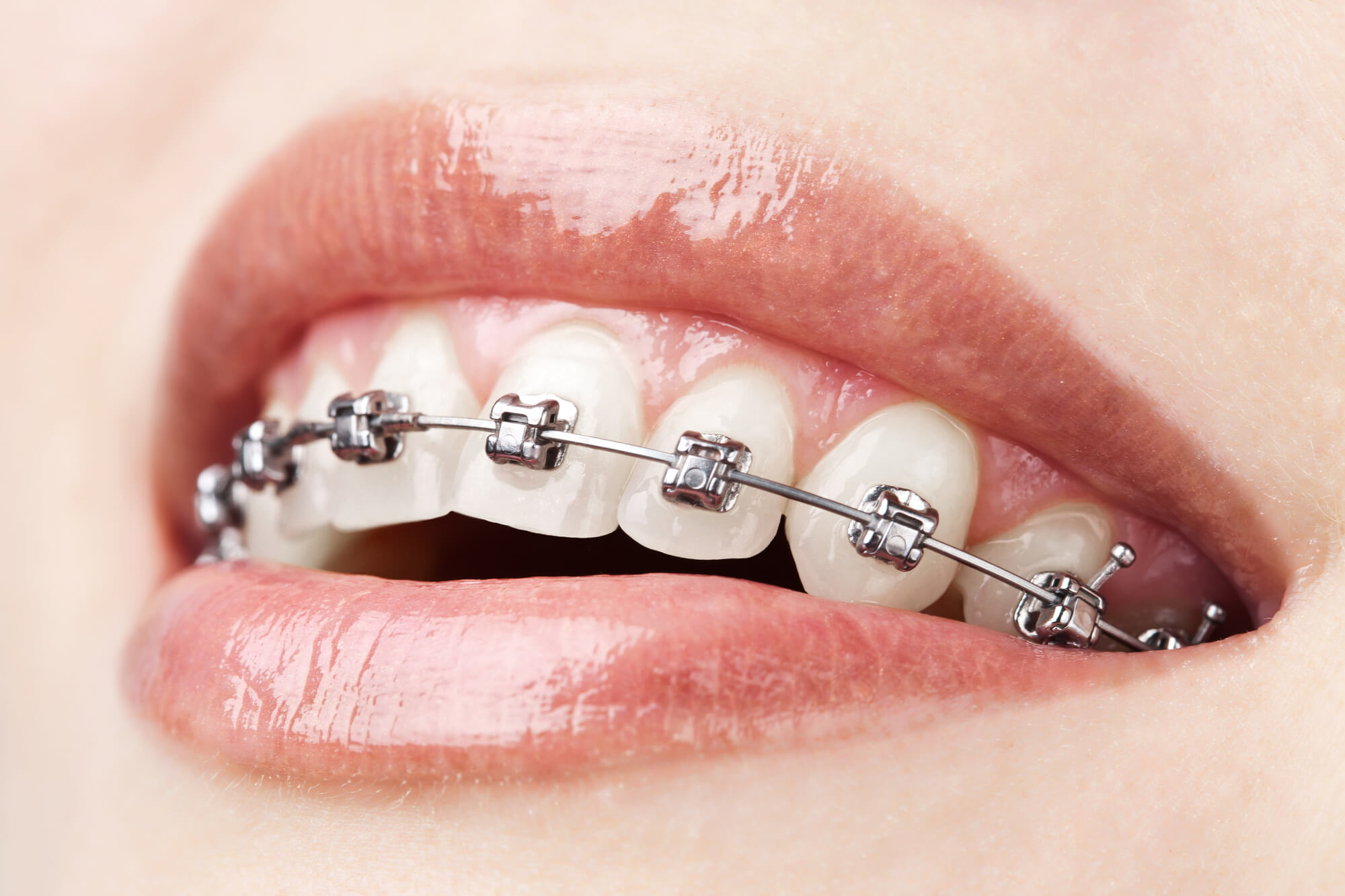 woman choosing metal braces over Invisalign in Greenville SC