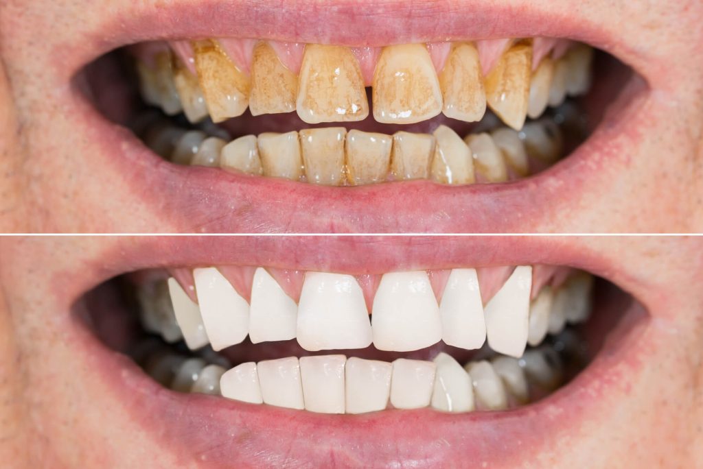 cosmetic dentist Greenville SC shows before and after image of a smile after teeth whitening