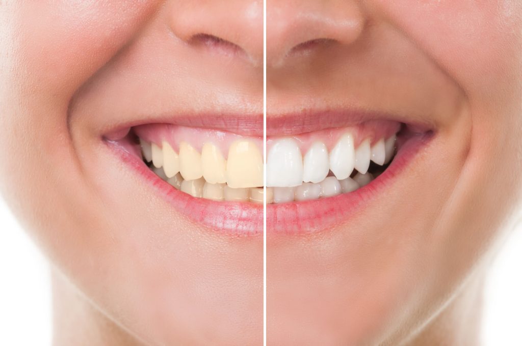 close up before and after teeth whitening in Greenville SC