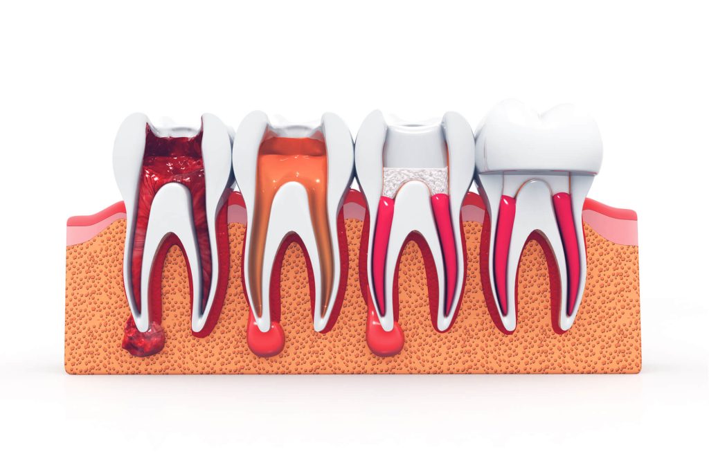 stages of root canal in Greenville SC