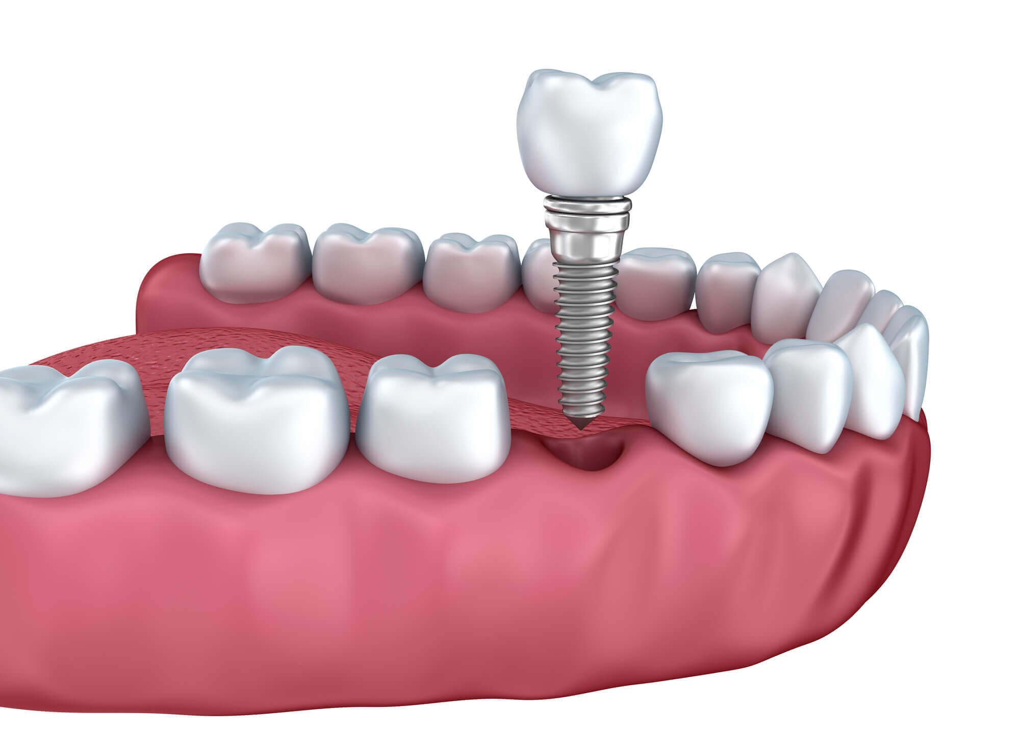 A sample of dental implants in Simpsonville SC.