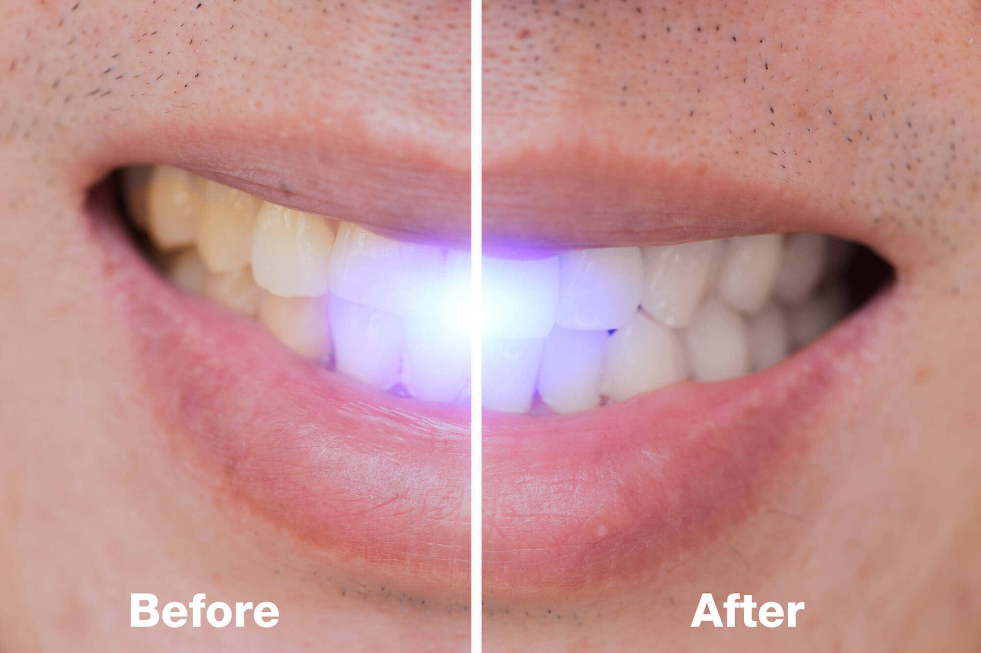 Laser whitening with a dentist in Simpsonville SC