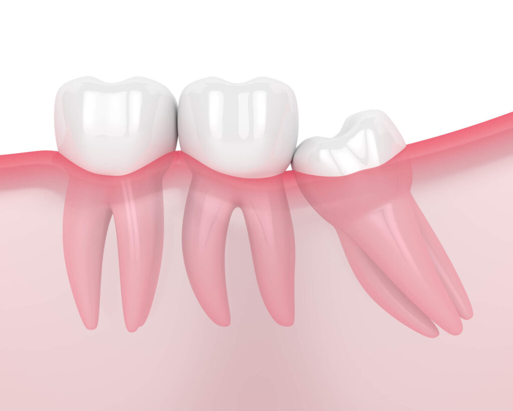 impacted wisdom teeth in Simpsonville SC