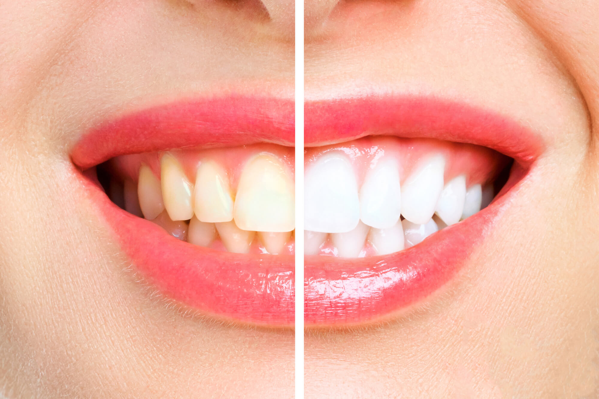 before and after teeth whitening Simpsonville