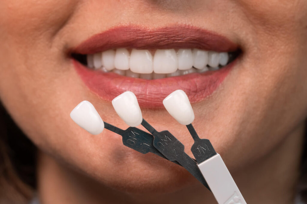 choosing shades for veneers in Greenville SC
