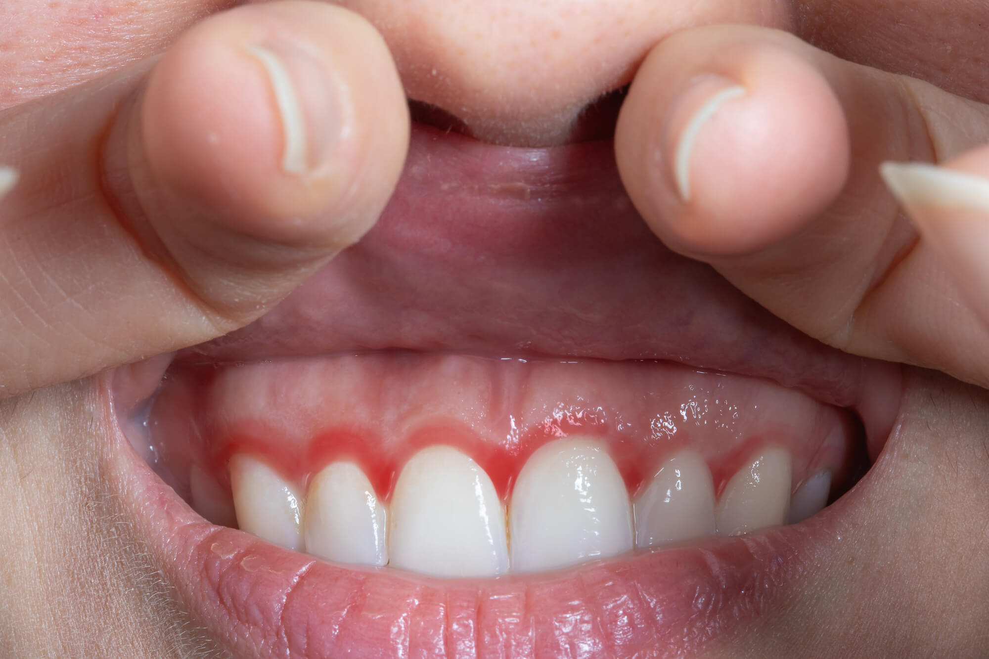 Dentist in Simpsonville SC Recommends Diet to Prevent Gum Disease